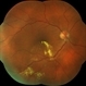 Retinal Arterial Macroaneurysm Retinal Arterial Macroaneurysm