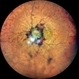 Idiopathic Intracranial Hypertension Idiopathic Intracranial Hypertension