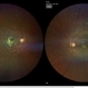 A rare case of a 45-year-old male with choroidal neovascular membrane in Familial Dominant Drusen (Doyne Honeycomb Drusen) in both eyes treated with intravitreal injections. A rare case of a 45-year-old male with choroidal neovascular membrane in Familial Dominant Drusen (Doyne Honeycomb Drusen) in both eyes treated with intravitreal injections.