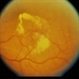 BDR / Macular Edema / Macroaneurysm BDR / Macular Edema / Macroaneurysm