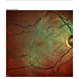Multi-Color Image of Epiretinal Membrane With Prominent Edge Superior Temporal Macula