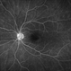 Hydroxychloroquine Maculopathy Hydroxychloroquine Maculopathy