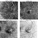 Macular Telangiectasia with Intraretinal CNV Macular Telangiectasia with Intraretinal CNV