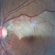 Branch Retinal Artery Occlusion Branch Retinal Artery Occlusion