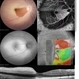 CRAO with cilioretinal sparing - Multimodal imaging CRAO with cilioretinal sparing - Multimodal imaging