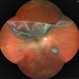 Giant Retinal Tear Giant Retinal Tear