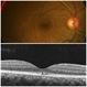 Arc Welder's Maculopathy Arc Welder's Maculopathy
