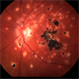 Presumed Ocular Histoplasmosis Syndrome