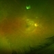IRVAN Syndrome