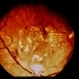 HTN / Macular Star / CWS HTN / Macular Star / CWS
