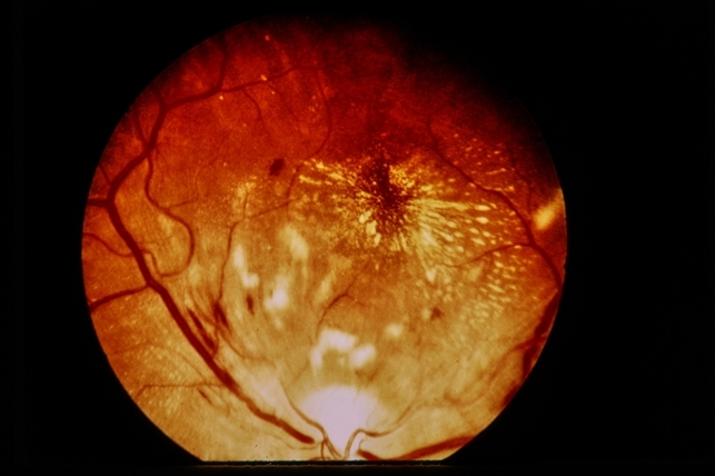 HTN / Macular Star / CWS - Retina Image Bank