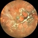 TRACTIONAL RETINAL DETACHMENT TRACTIONAL RETINAL DETACHMENT