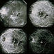 Myopia Myopia