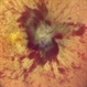 Idiopathic Intracranial Hypertension Idiopathic Intracranial Hypertension