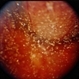 Choroidal Melanoma With Vitreous Seeding Choroidal Melanoma With Vitreous Seeding