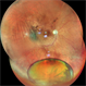 Dropped Nucleus With Disc Pallor With Posterior Pole Retinal Detachment Dropped Nucleus With Disc Pallor With Posterior Pole Retinal Detachment