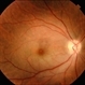 Central Retinal Artery Occlusion Central Retinal Artery Occlusion