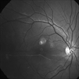 Retinal Detachment Sparing Fovea By Microns Retinal Detachment Sparing Fovea By Microns