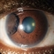 Ciliary Body Metastasis Ciliary Body Metastasis