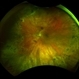 Alagille Syndrome UWF Color Alagille Syndrome UWF Color