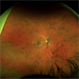 CHRPE Spots CHRPE Spots