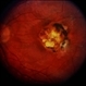 Toxoplasmosis / Macular Scar / Active Toxoplasmosis / Macular Scar / Active