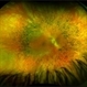 Retinitis Pigmentosa Retinitis Pigmentosa
