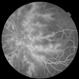 Branch Retinal Vein Occlusion-Posterior Hyaloid Proliferation