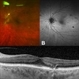 Late Findings in c=Cryptococcal Choroiditis Late Findings in c=Cryptococcal Choroiditis