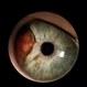 New Iris Melanoma New Iris Melanoma