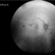 Autofluorescence in Multiple Choroidal Ruptures