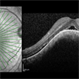 Choroidal Hemangioma Choroidal Hemangioma