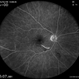 Branch Retinal Artery Occlusion Branch Retinal Artery Occlusion