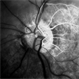 Branch Retinal Artery Occlusion With Calcium Embolus at the Disc - Fundus  Fluorescence Angiogram (FA) Branch Retinal Artery Occlusion With Calcium Embolus at the Disc - Fundus  Fluorescence Angiogram (FA)