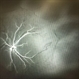 Persistent Fetal Vasculature