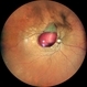 Pre-retinal Hemorrhage Pre-retinal Hemorrhage