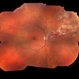 Cytomegalovirus Retinitis Cytomegalovirus Retinitis