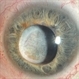 Chronic Regmatogenous Retinal Detachment Chronic Regmatogenous Retinal Detachment