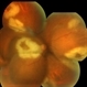 Progressive Outer Retinal Necrosis