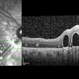 Submacular PFO Submacular PFO