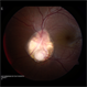 Optic Disc Coloboma Optic Disc Coloboma
