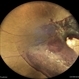 SUB HYALOID HEMORRHAGE