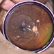 Tuberculoma Tuberculoma