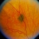 Choroidal Melanocytosis