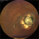 Morning Glory Anomaly with Macular Atrophy Morning Glory Anomaly with Macular Atrophy