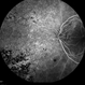 Possible Uveitis or RP Variant Possible Uveitis or RP Variant