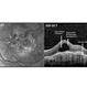 Outer Retinal Tubulation Outer Retinal Tubulation