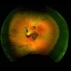 Before & After - YAG Laser Hyaloidotomy for Subhyaloid Hemorrhage