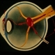 Retinoblastoma Retinoblastoma