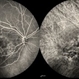 Fluorescein and Indocyanine Green Angiography in Right Eye in Case of Choroidal Hemangioma Fluorescein and Indocyanine Green Angiography in Right Eye in Case of Choroidal Hemangioma